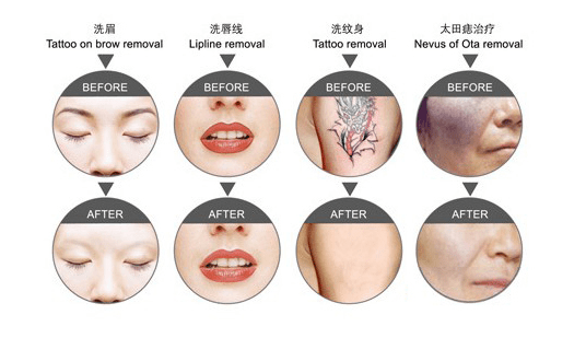 professional laser tattoo removal price yag directly sale for skin-1