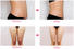 heathy liposuction machine manufacturers design for body