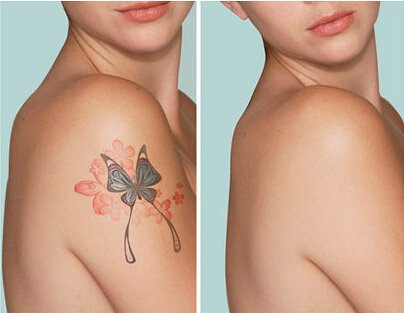 best selling laser tattoo removal price removal directly sale for woman-5