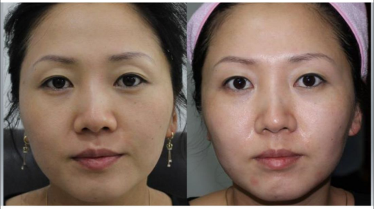 Tingmay bio ultrasound facelift from China for woman-9