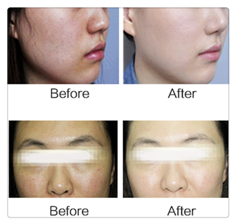 mini scrubber ultrasonic facial directly sale for beauty salon-1